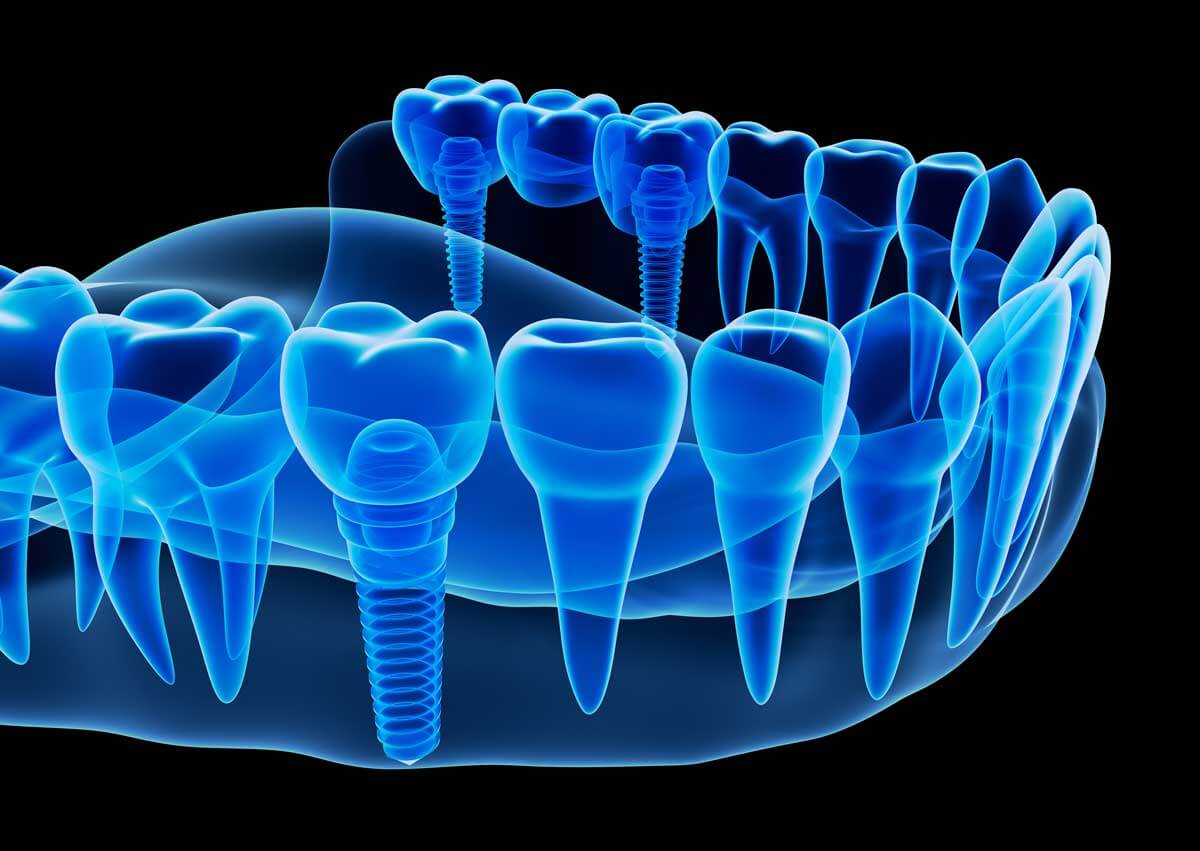 Photo Cone Beam Scanner or Patient